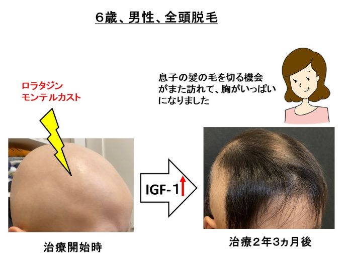 円形脱毛症　病院